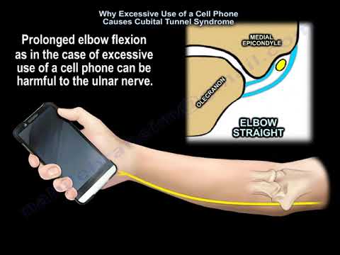 Why Excessive Use of a Cell Phone Causes Cubital Tunnel Syndrome