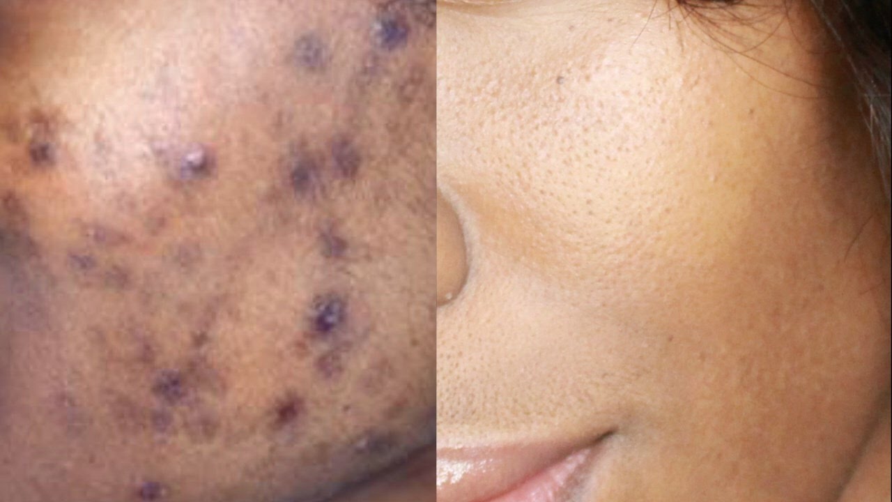HOW TO GET RID OF HYPERPIGMENTATION, ACNE SCARS & DARK SPOTS  NATURALLY