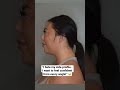How To Lose Facial Fat Buccal Fat Removal And Chin Liposuction Beforeandafter