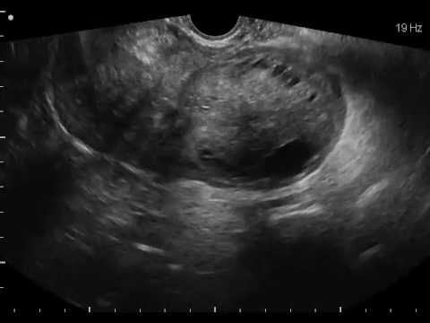 Hypertension intracrânienne nouveau-né Sauts brusques de la pression artérielle chez les femmes