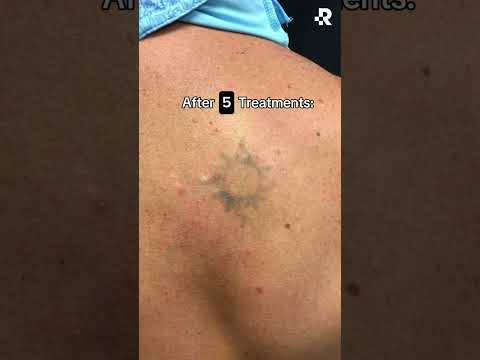 Before & After 8 Tattoo Removal Treatments!🤩