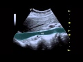 Ultrasound of the IVC