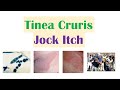 Jock Itch (Tinea Cruris) | Causes, Risk Factors, Signs & Symptoms, Diagnosis and Treatment