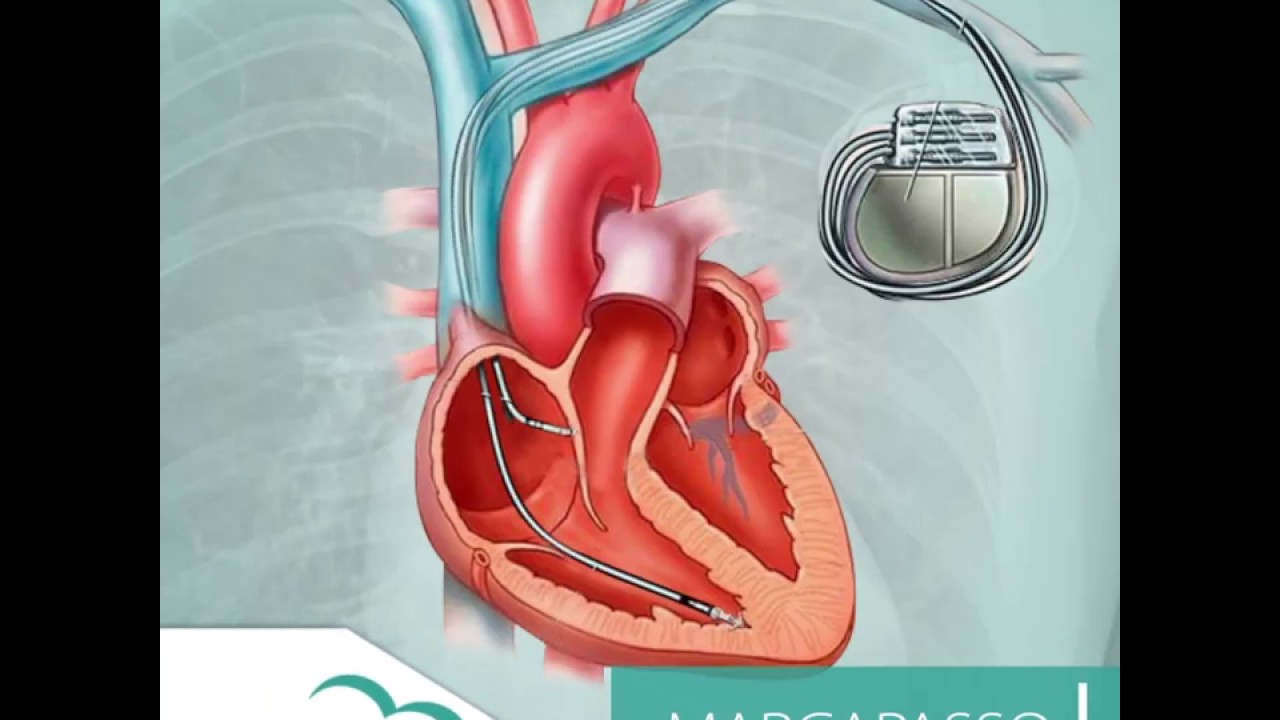 Marcapasso - Oque é Como funciona