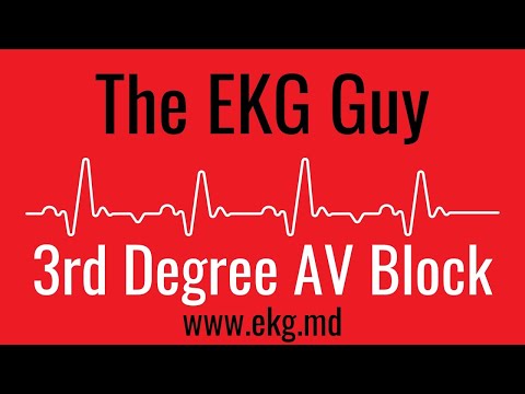 Third Degree AV Block EKG l The EKG Guy - www.ekg.md