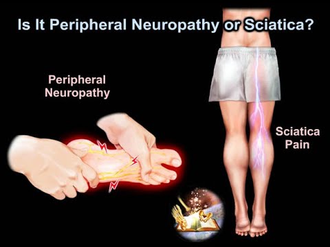 Ist es periphere Neuropathie oder Ischias – alles, was Sie wissen müssen – Dr. Nabil Ebraheim