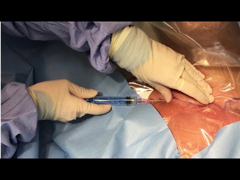 LANDMARK-guided Subclavian Central Line Insertion (in real-time)