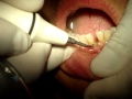 Profilaxis (Limpieza Dental) 