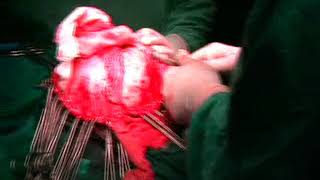 Calvarial bone graft harvesting