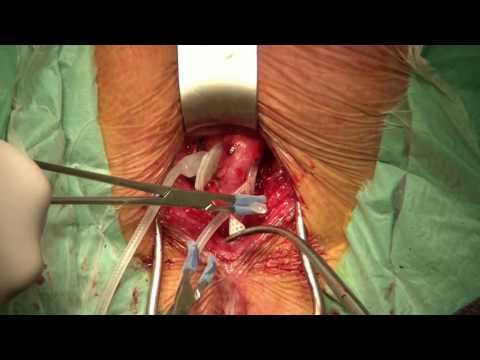 Artificial Urinary Sphincter AMS 800