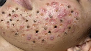 Loan Nguyen Acne Treatment 0.n