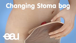 Changing stoma bag (after bladder cancer treatment)