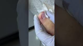Ep_8294 Foot nails skin removal 👣 ตัวที่ทำให้หนูปวดตอนกลางคืน 😄 (clip from Thailand)