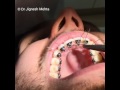 Lingual Braces Teeth Clip Invisible Braces