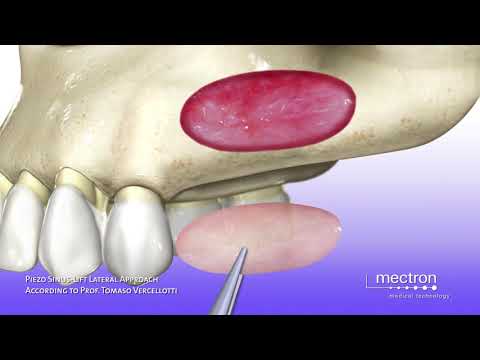 PIEZOSURGERY®  Sinus Lift Technique by lateral