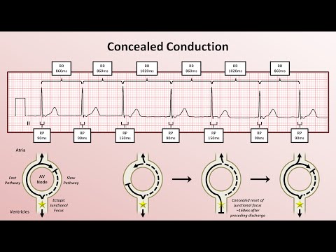 Advanced EKGs - Miscellaneous EP Topics