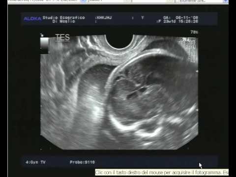 Uccidere vermi al bambino Che fare se ha rimedi di gente di vermi