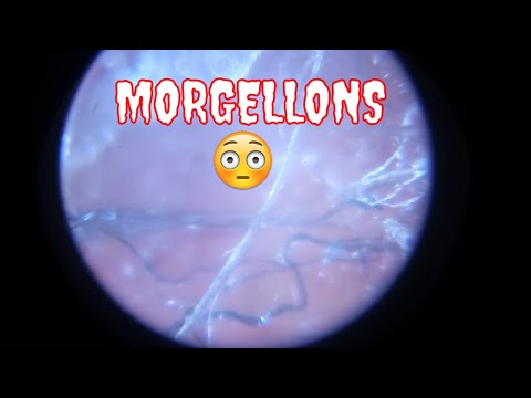 Morgellons Snow Storm 2017 🌠🖕