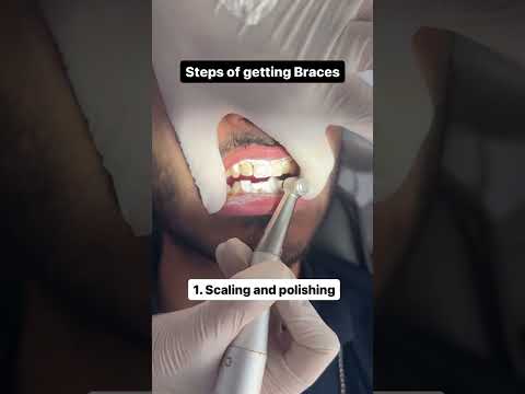 3 Steps of Getting Braces | Braces Procedure in Lahore | Orthodontic Treatment | Dental Aesthetics