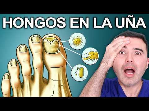 NO MORE FOOT FUNGUS - How to Eliminate Foot Fungus and Never Feel Embarrassed Again