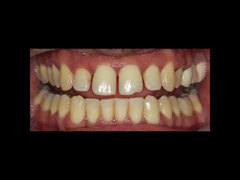 Can Invisalign close spaces?