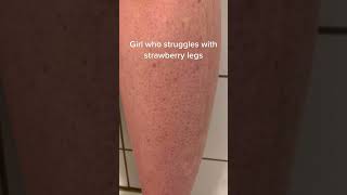 Strawberry legs WHO? #keratosispilaris #strawberrylegs