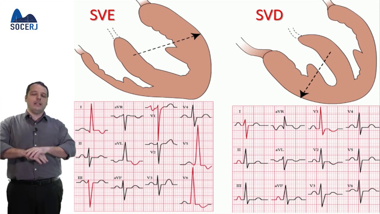 Curso Básico de ECG - Aula 04:  Sobrecargas Cavitárias