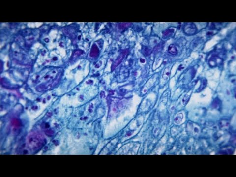 NYC Health Officials Investigating Another Case Of Monkeypox