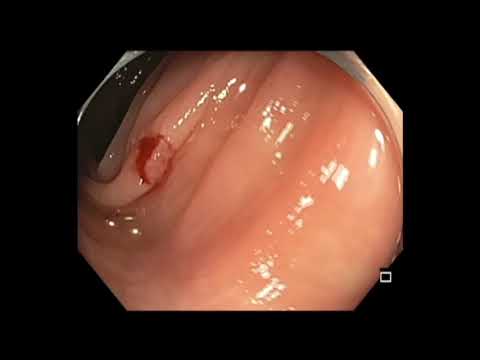 Colonoscopy: Cold Snare a Polyp - Resnare and Complete the Resection