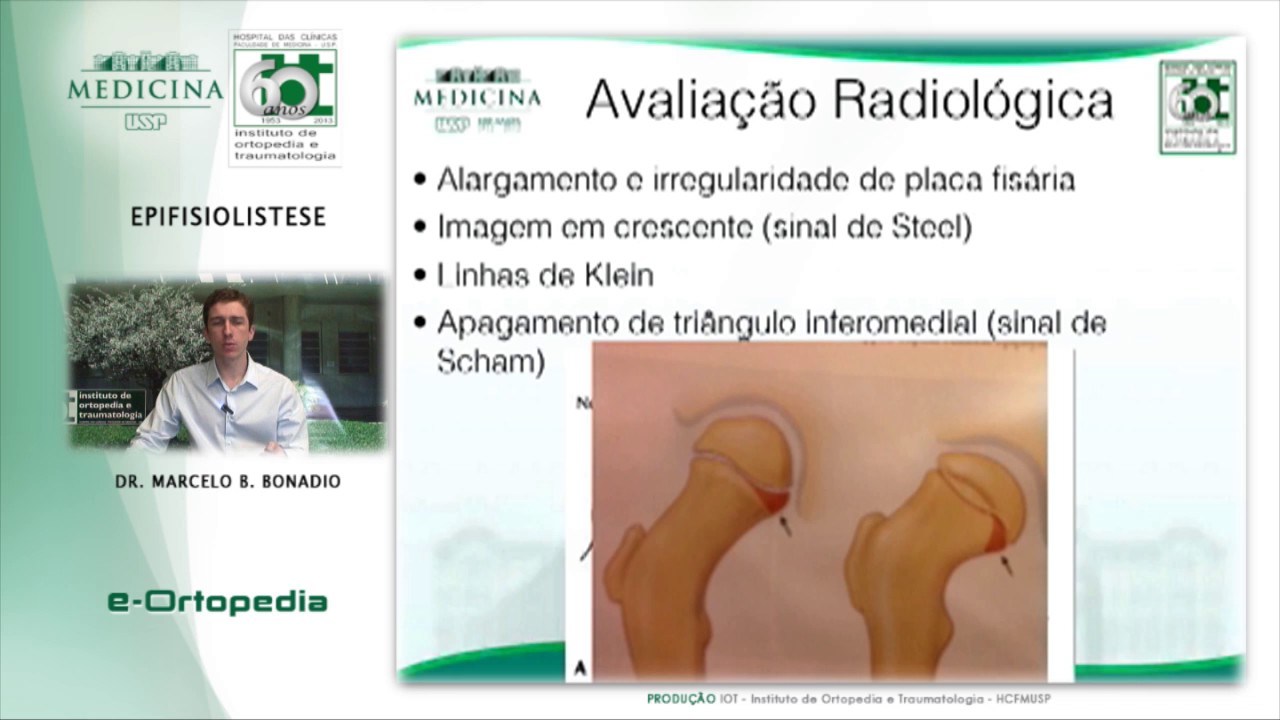 Epifisiolistese - Dr. Marcelo Batista Bonadio