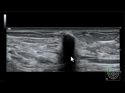 Significado das sombras acústicas intensas na ultrassonografia mamária