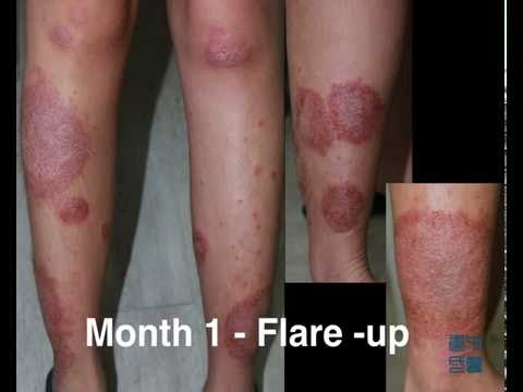 Al bambino che le analisi consegnare la dermatite atopic Cura di psoriasi di piatti di unghia