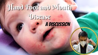 Hand Foot and Mouth Disease in Children - A Discussion || Dr. Vivasvan Parekh