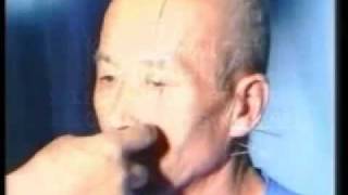 ACUPUNTURA CURITIBA -TRATAMENTO CHINÊS DA PARALISIA FACIAL