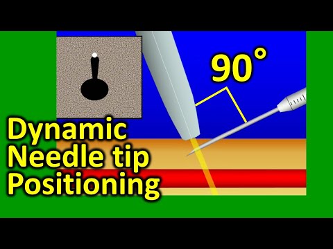 Ultrasound guided dynamic needle tip positioning in peripheral vein and artery cannulation