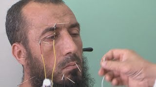 Traditional Chinese acupuncture gains popularity in Algeria