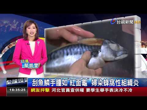 刮魚鱗手腫如紅面龜 婦染蜂窩性組織炎