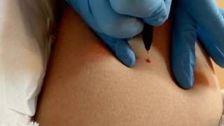 Blood Spot Removal in In-DERM Skin Clinic