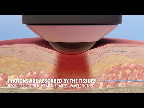 How Deep Tissue Laser Therapy Works by LightForce