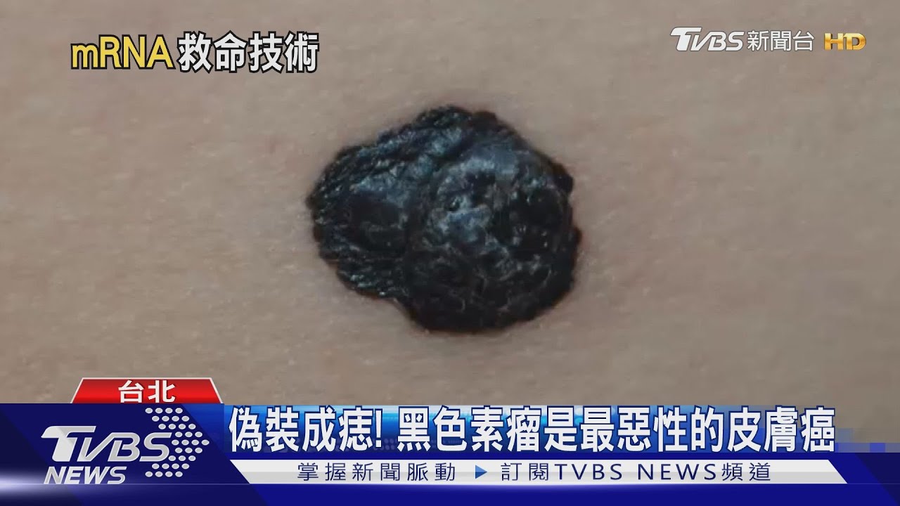 莫德納疫苗技術　成功降低「這致命癌症」復發率！癌症疫苗不遠了?