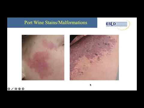 ESLD Thursday - Novembre 2025 - Treatment of Port Wine Malformations