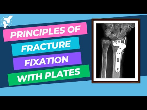 Principes de la Fixation des Fractures avec des Plaques