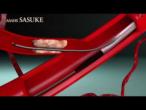 Access to Side Branch Occlusion with ASAHI SASUKE Double Lumen Catheter