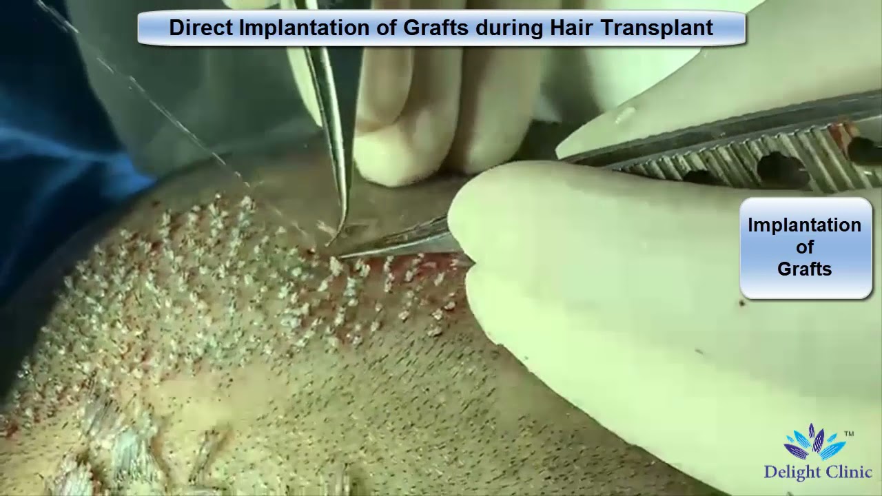 Direct Implantation of Grafts during Hair Transplant