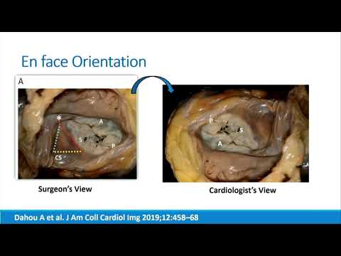 CVI 2019_Thursday 7/18_ The Problem of Tricuspid Regurgitation_Rebecca Hahn, MD