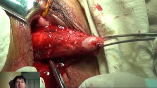 DESCENSO DE ÚTERO Y VEJIGA. COLPOCLEISIS