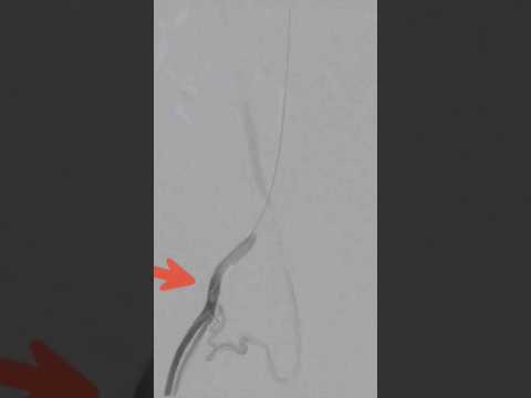 Varicocele embolization live case - Step 6 #nosurgery | Dr. Gaurav Gangwani