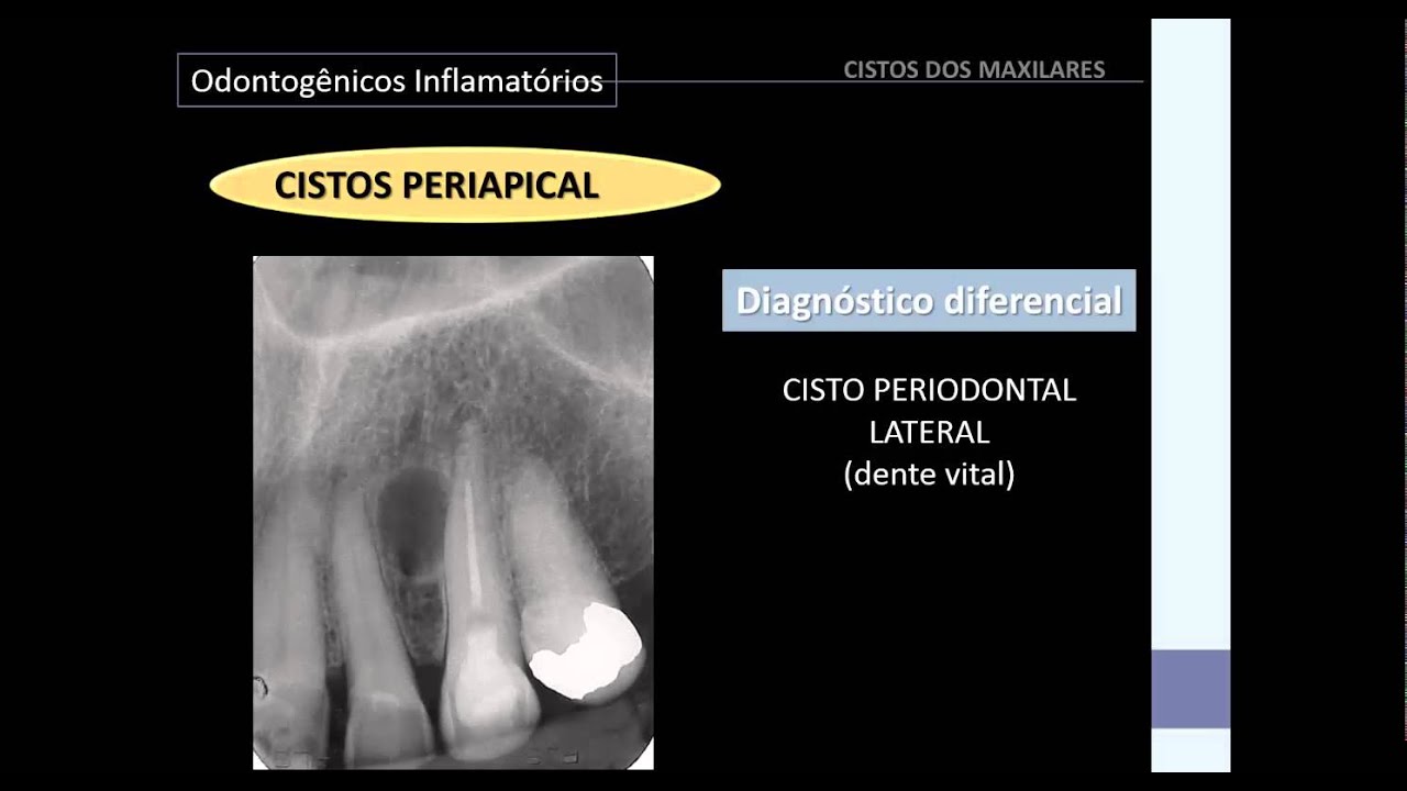 Cistos dos Maxilares