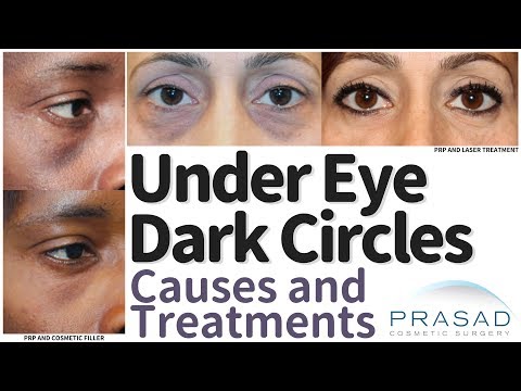 What Causes Under Eye Dark Circles, and How they are Treated