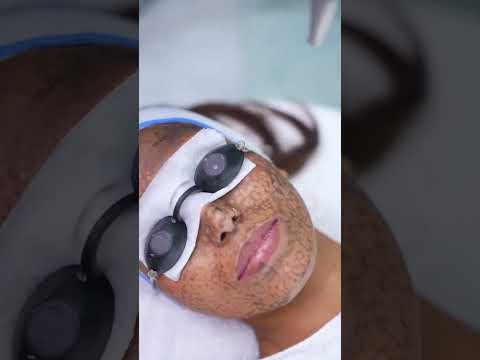 Experience the Glow: Carbon Peel Facial Benefits by Pooja Goel!